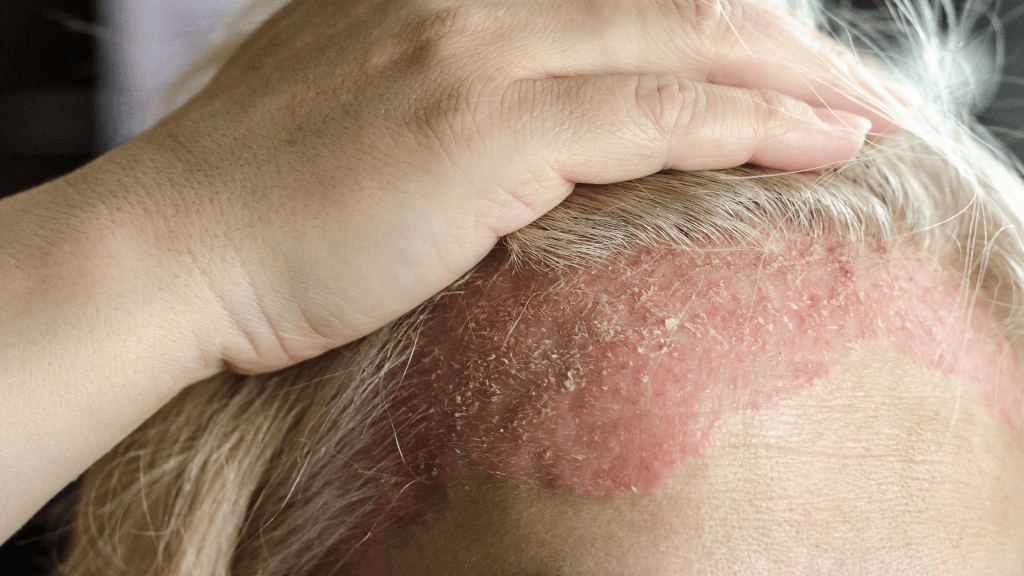 Problemas dermatológicos ligados à saúde mental a conexão corpo-mente