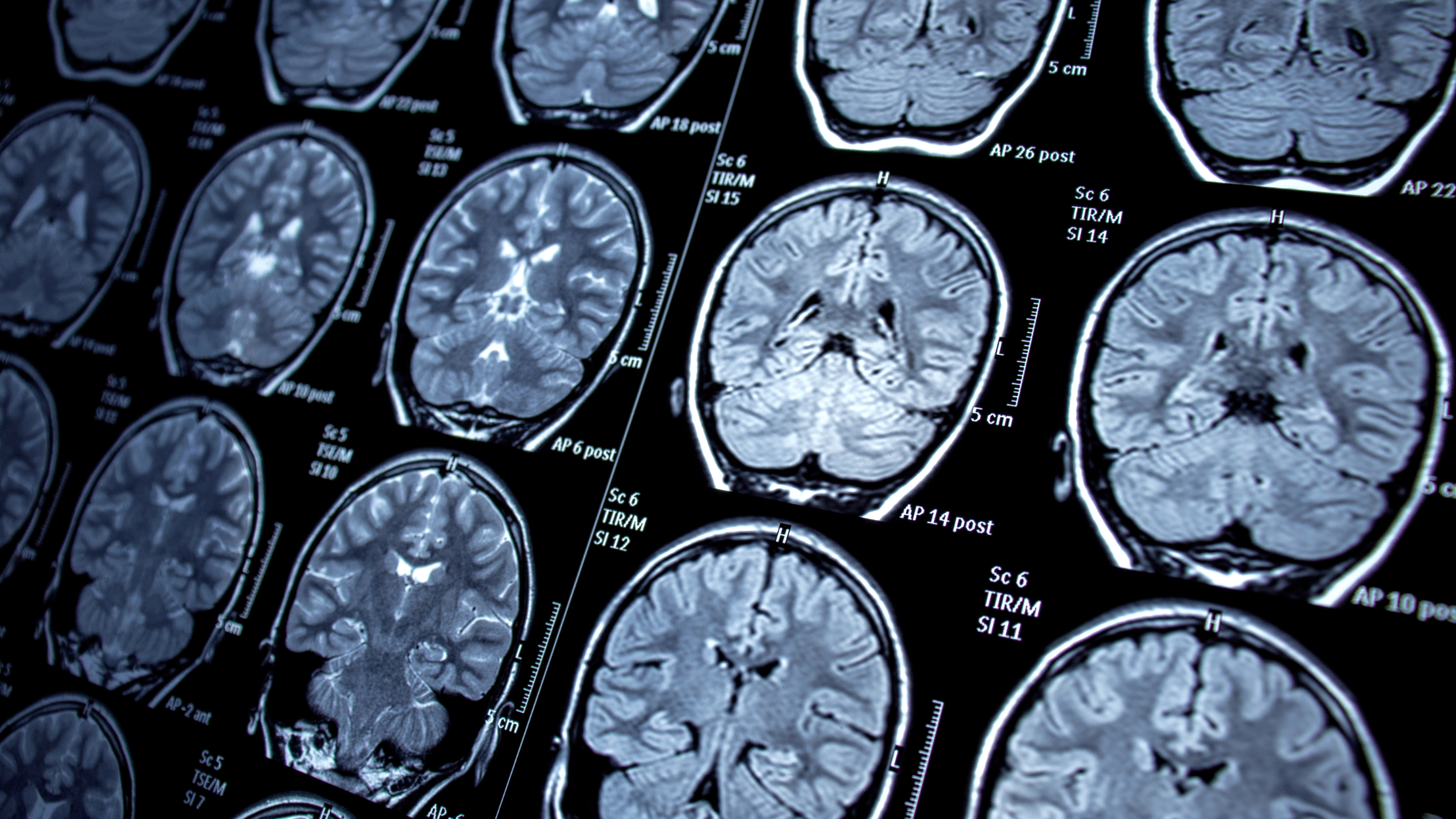Tipos de doenças neurológicas e quais os sintomas